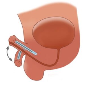 تصویر آلت تناسلی دارای پروتز نیمه منعطف