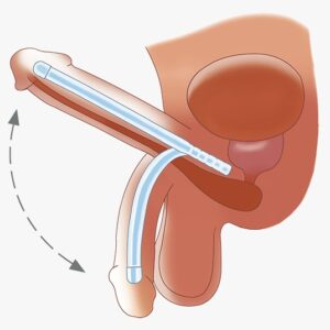 تصویر آلت داراری پروتز مالیبل