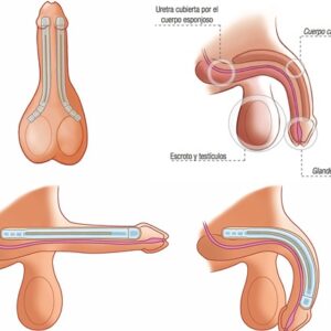 تصویر پروتز آلت مالیبل