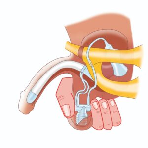 تصویر پروتز آلت هیدرولیک ZSI