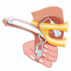 تصویر پروتز آلت هیدرولیک ZSI