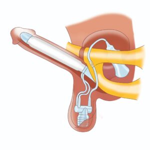 تصویر پروتز آلت هیدرولیک ZSI
