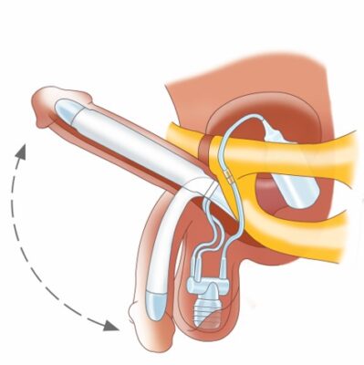 تصویر پروتز آلت هیدرولیک ZSI