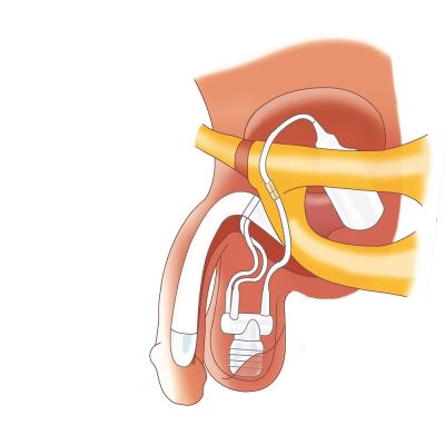 پروتز آلت هیدرولیکی