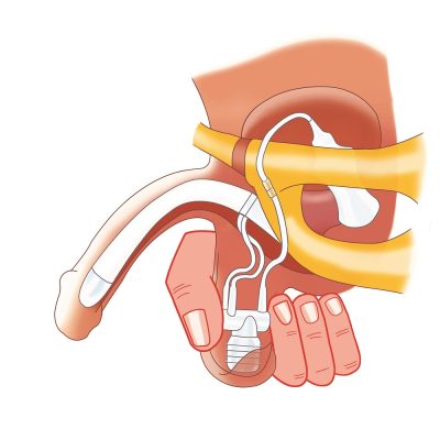 پروتز آلت هیدرولیکی