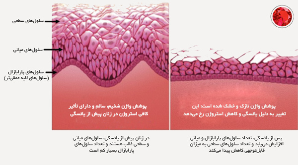 درمان آتروفی واژن